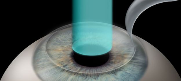 LASIK (Laser In situ Keratomileusis)