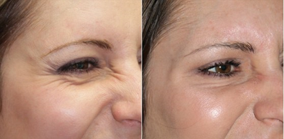 OCULOPLASTY