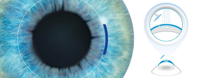 RELEX SMILE SURGERY